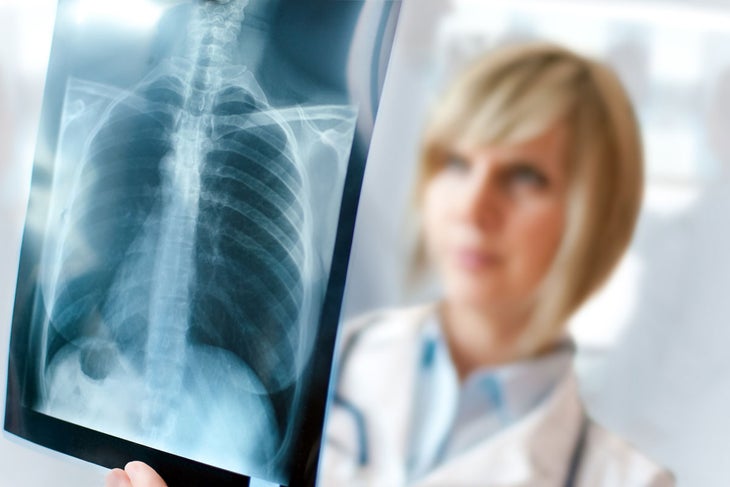 x-ray Pneumonia and bronchitis can happen when a cold/flu is not properly treated or becomes chronic.